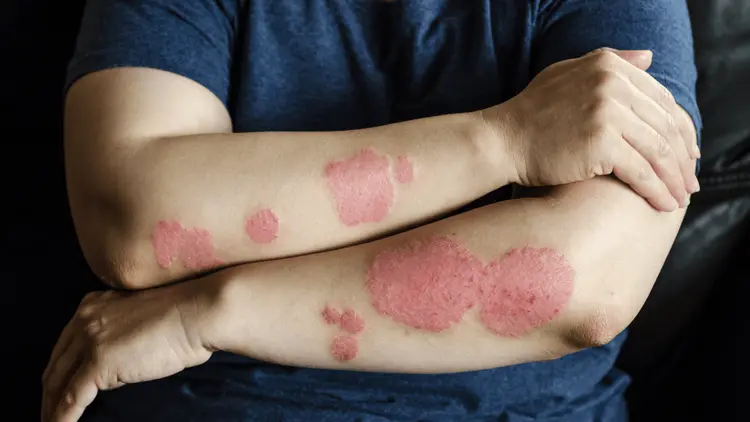 CBD na dermatologia: o papel da cannabis no tratamento de doenças de pele