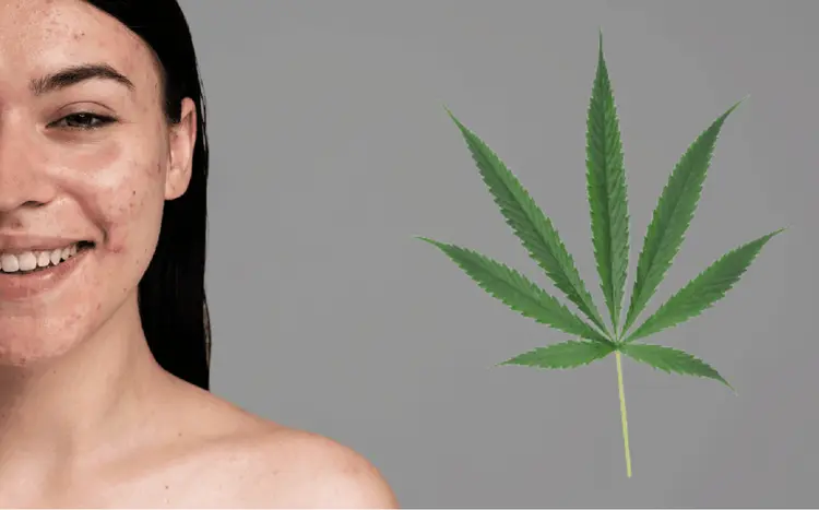 Estudo: canabinoides menos conhecidos podem ajudar a pele contra dermatite, psoríase e acne